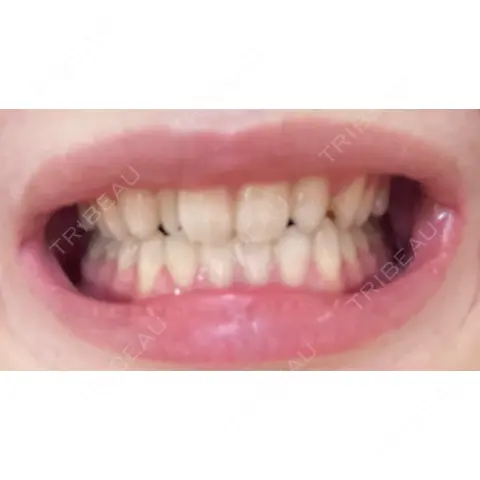 ホワイトニング LEAGRANT CLINIC 中目黒 AFTER