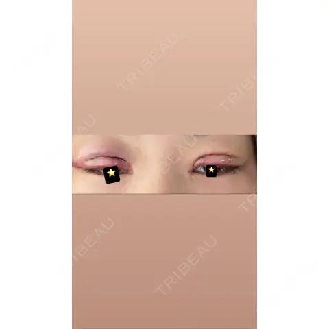 目頭切開 / 眼瞼下垂（切開） / 上まぶたの脂肪取り いちのせ形成外科・皮膚科 眼瞼＆フェイスクリニック DAY 1