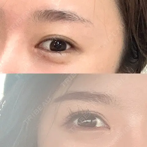 目頭切開 HAAB×DREAM BEAUTY CLINIC 大阪梅田院 AFTER