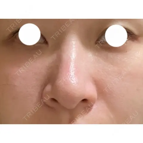 クマ治療 / PRP皮膚再生療法 / その他（口元） Pono clinic 【ポノクリ】 AFTER