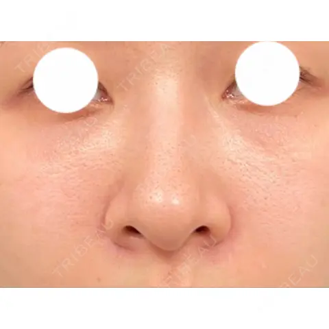 クマ治療 / PRP皮膚再生療法 / その他（口元） Pono clinic 【ポノクリ】 AFTER