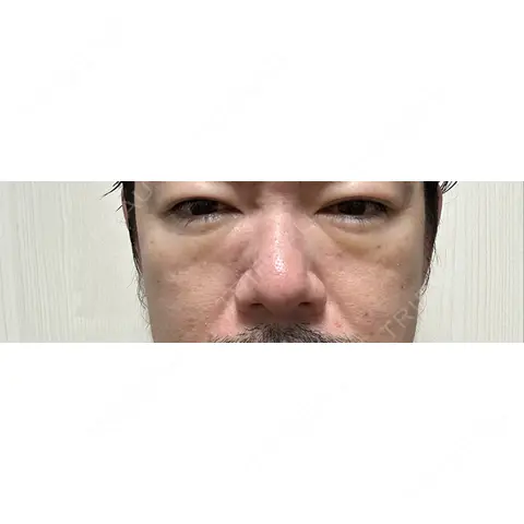 クマ治療 / PRP皮膚再生療法 Pono clinic 【ポノクリ】 AFTER