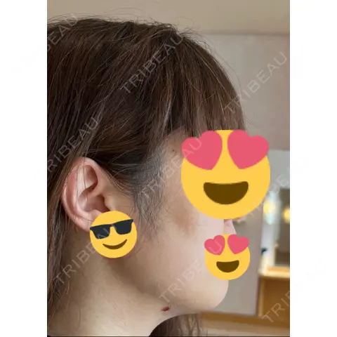 脂肪吸引（顔） 湘南美容クリニック 札幌院 DAY 0