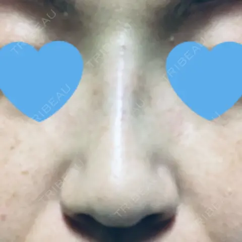 ヒアルロン酸注入（鼻） アクトリー勝どきウェルネスメディカルクリニック DAY 0