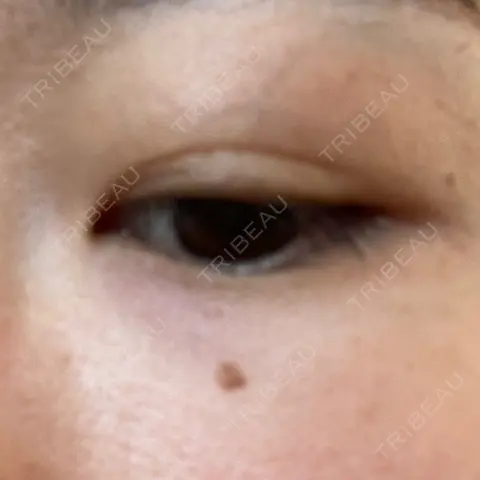 ボトックス（口角） / ボトックス（人中） / その他（目元） ルラ美容クリニック 渋谷本院 AFTER