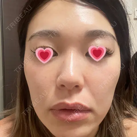 光治療（フォトフェイシャルなど） APOLLO BEAUTY CLINIC DAY 0