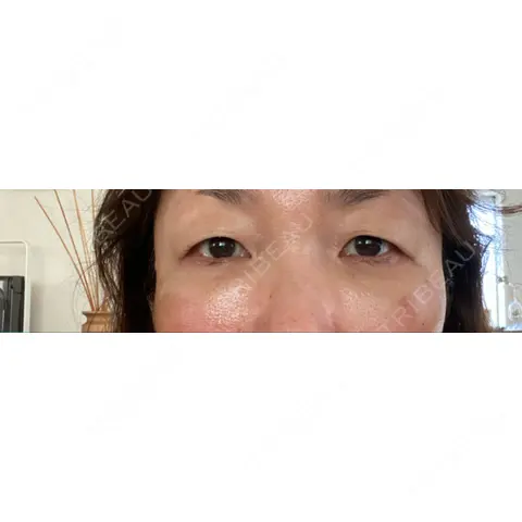 クマ治療 / PRP皮膚再生療法 Pono clinic 【ポノクリ】 AFTER