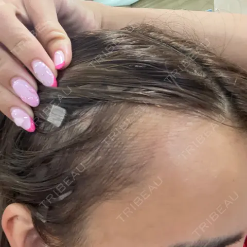 アートメイク（ヘアライン） Tokyo Tensei Clinic 新宿院 DAY 0