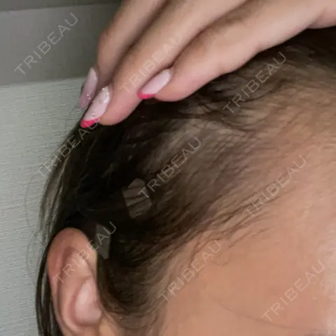 アートメイク（ヘアライン） Tokyo Tensei Clinic 新宿院 AFTER