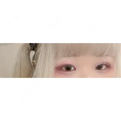 二重埋没 / 上まぶたの脂肪取り AI Beauty Clinic （エーアイ美容クリニック） AFTER