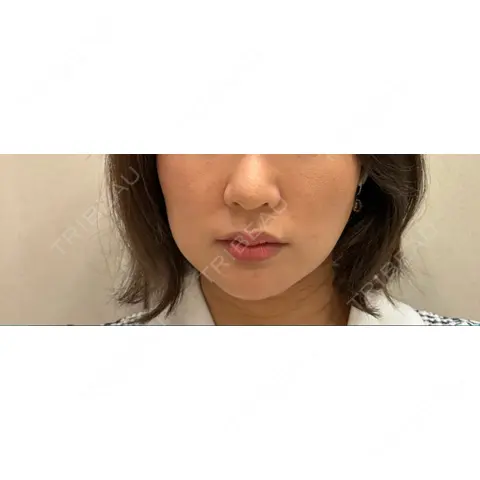 ニードルRF（ポテンツァなど） ゆう美容クリニック AFTER