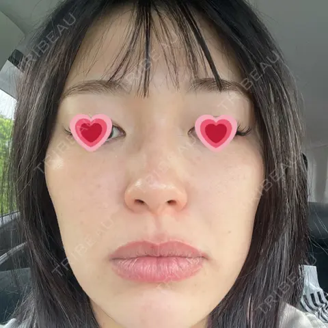 光治療（フォトフェイシャルなど） APOLLO BEAUTY CLINIC AFTER