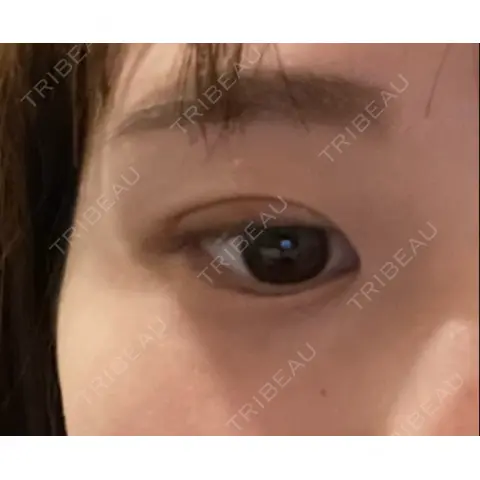 二重埋没 9BeautyClinic DAY 0