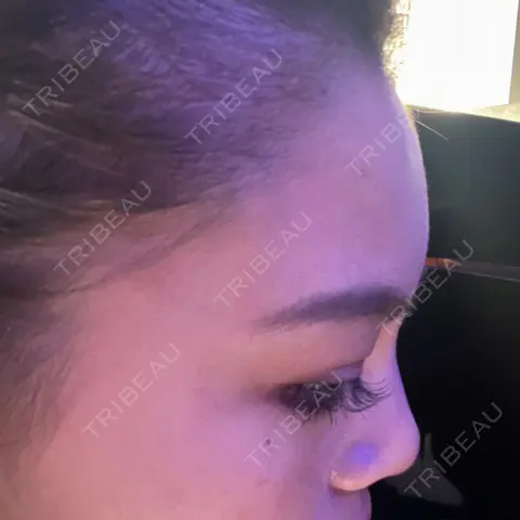 アートメイク（ヘアライン） Tokyo Tensei Clinic 新宿院 DAY 0