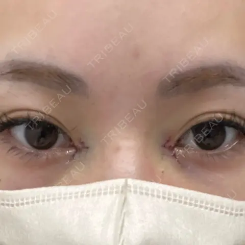 目頭切開 AI Beauty Clinic （エーアイ美容クリニック） DAY 0