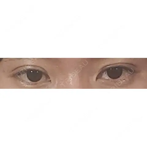 二重埋没 東京イセアクリニック AFTER
