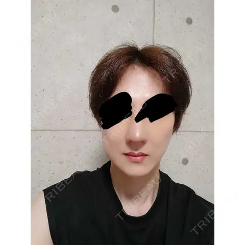 鼻修正 / 鼻尖縮小 id（アイディ）美容外科 DAY 7