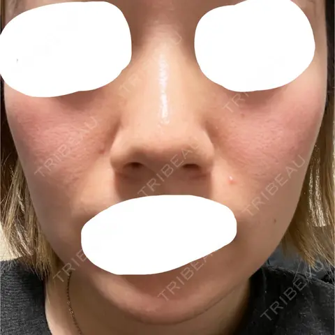 ダーマペン VENUS BEAUTY CLINIC　銀座院 AFTER