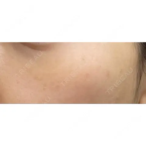 シミ取りレーザー / ピコレーザートーニング（美白・肝斑） PICO BEAUTY CLINIC AFTER