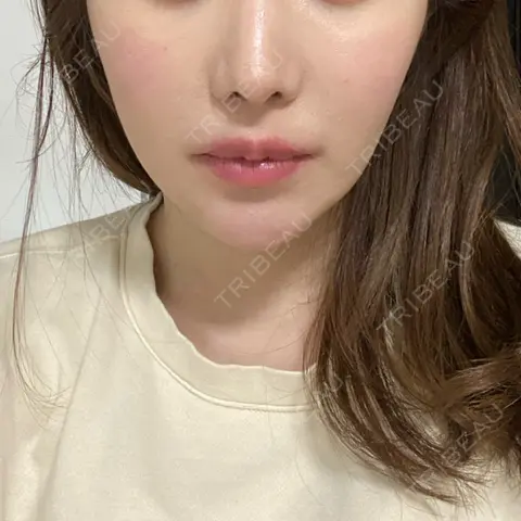 ヒアルロン酸注入（頬） 湘南美容クリニック 渋谷アネックス院 AFTER