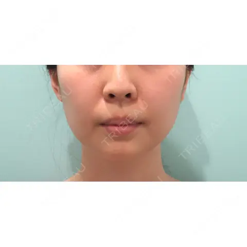 糸リフト / 脂肪吸引（顔） / 脂肪注入（輪郭） WOM CLINIC GINZA （ワム クリニック ギンザ） BEFORE