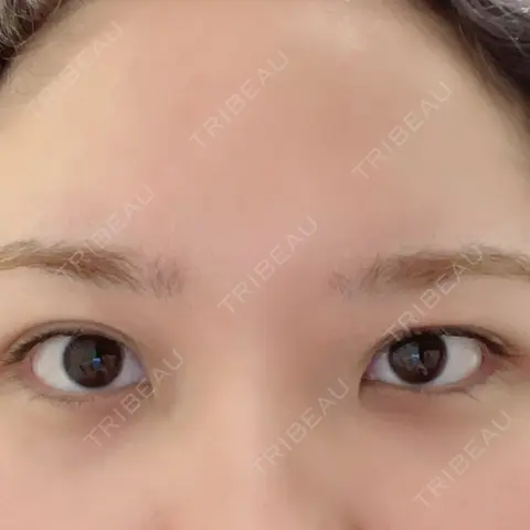 目頭切開 湘南美容クリニック 熊本院 AFTER