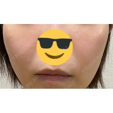 シミ取りレーザー PICO BEAUTY CLINIC AFTER