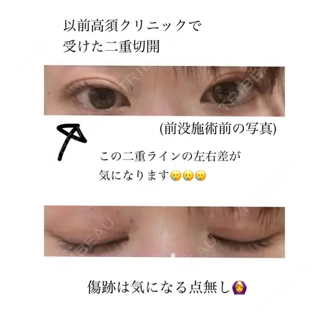 二重埋没 / 二重切開 / 目元修正 共立美容外科 仙台院 AFTER