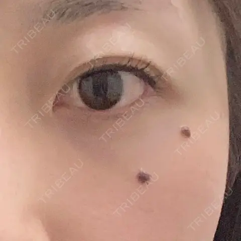ほくろ・いぼ切除（肌） TCB東京中央美容外科 川口院 AFTER