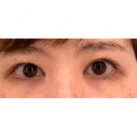 二重切開 OZI SKIN CLINIC（オジスキンクリニック） AFTER