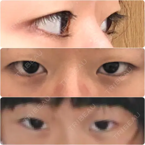 二重切開 / 眼瞼下垂（切開） 蘇春堂形成外科 AFTER