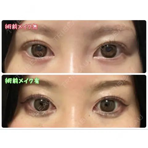 蒙古ひだ形成 R.O.clinic AFTER