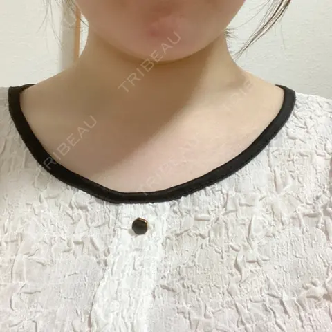 ボトックス（肩） 湘南美容クリニック 渋谷アネックス院 AFTER