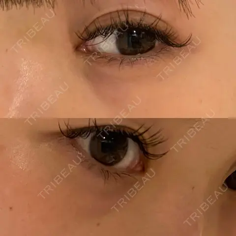 下まぶたの脂肪取り APOLLO BEAUTY CLINIC AFTER