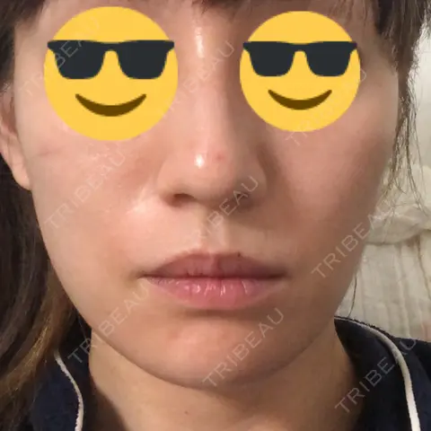 糸リフト 豊洲佐藤クリニック AFTER