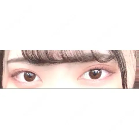 二重埋没 / ヒアルロン酸注入（涙袋） A CLINIC（エークリニック） 銀座院 AFTER