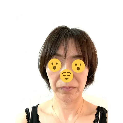プラセンタ注射 / ハイフ（顔） 心斎橋藤井クリニック AFTER