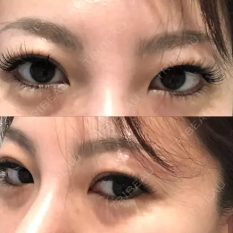下まぶたの脂肪取り / 眉下切開 ヴェリテクリニック 名古屋院 AFTER