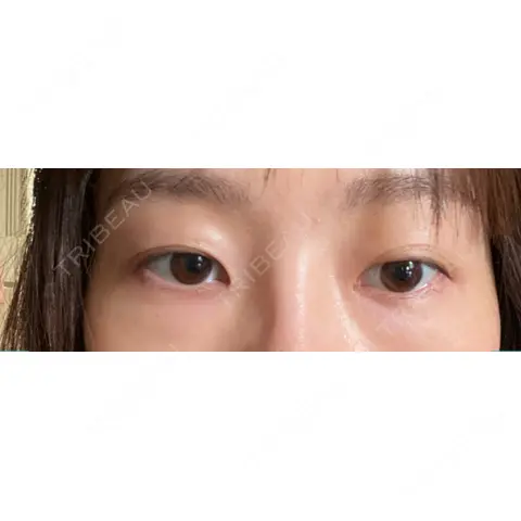 眼瞼下垂（切開） 札幌ル・トロワ ビューティクリニックVogue AFTER