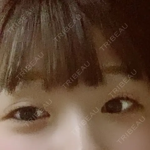 二重埋没 広島中央クリニック AFTER