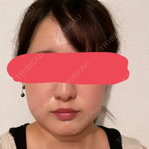 糸リフト / バッカルファット除去 / 脂肪吸引（顔） / メーラーファット除去 SEA CLINIC（シークリニック） AFTER