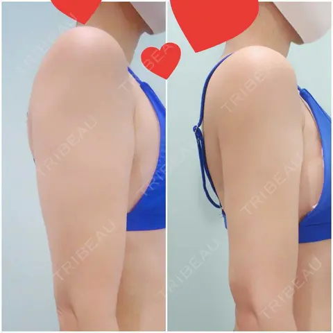 脂肪吸引（二の腕） WOM CLINIC GINZA （ワム クリニック ギンザ） AFTER