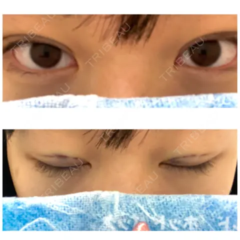 二重埋没 広島中央クリニック AFTER