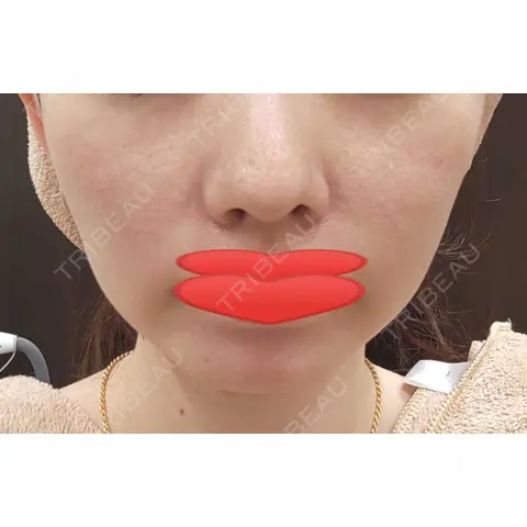 光治療（フォトフェイシャルなど） 東京美容皮膚科CLINIC AFTER
