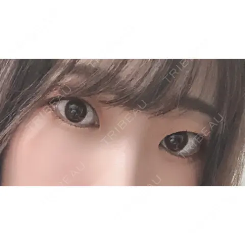 ヒアルロン酸注入（涙袋） フィラークリニック 横浜院 AFTER
