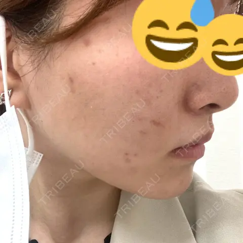 ハイフ（顔） TCB東京中央美容外科 福岡博多院 AFTER
