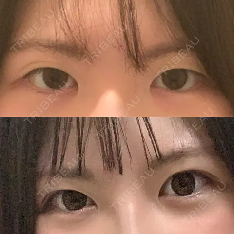 二重切開 水の森美容クリニック 東京銀座院 AFTER