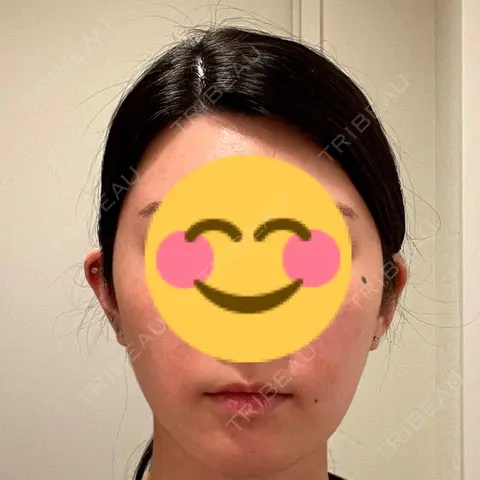 アートメイク（唇） LEAGRANT CLINIC 中目黒 AFTER