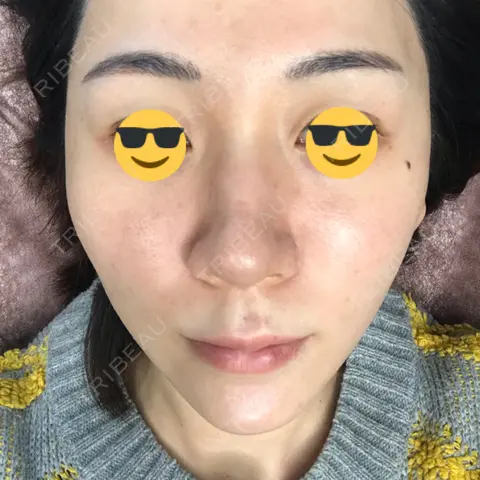 アートメイク（唇） LEAGRANT CLINIC 中目黒 AFTER