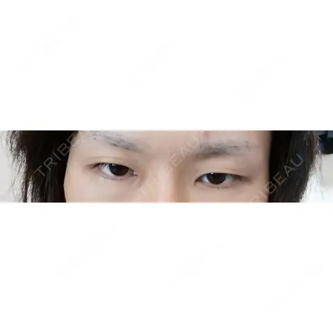二重埋没 / ヒアルロン酸注入（涙袋） THE CLINIC NAGOYA AFTER